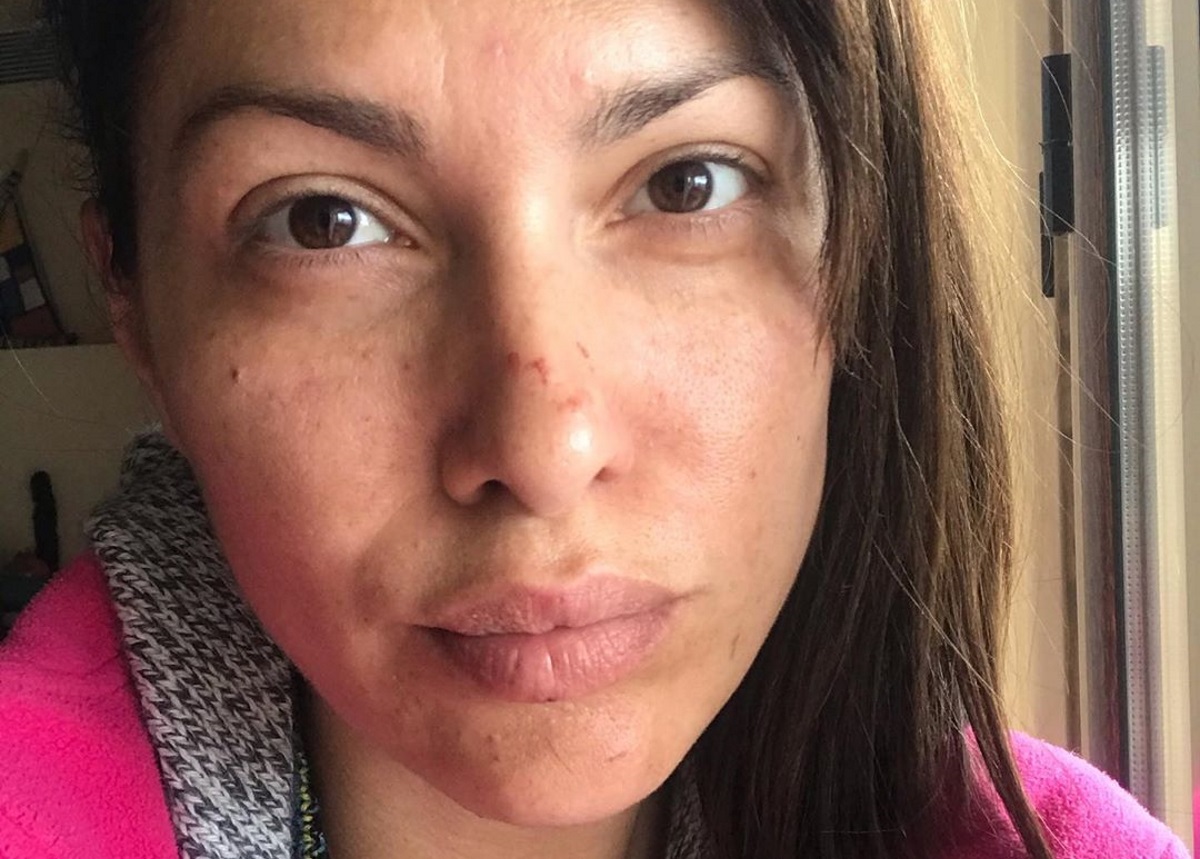 Κλέλια Ρένεση: Μας δείχνει το γεμάτο γρατζουνιές πρόσωπό της – Τι συνέβη;