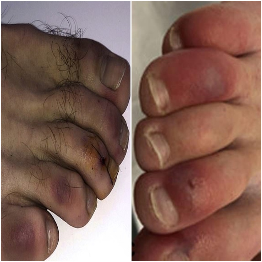 Απίστευτο! Τα μωβ δάχτυλα μετά από κορονοϊό, μπορεί να παραμείνουν 5 μήνες μετά την ανάρρωση λένε οι επιστήμονες