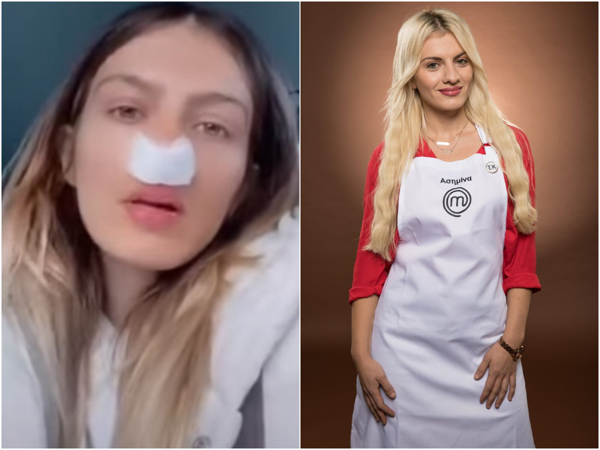 Ασημίνα Ουστάλλι – MasterChef: «Υποφέρω πολύ, δε μπορώ να αναπνεύσω» λέει μετά τις δύο αποτυχημένες πλαστικές στη μύτη