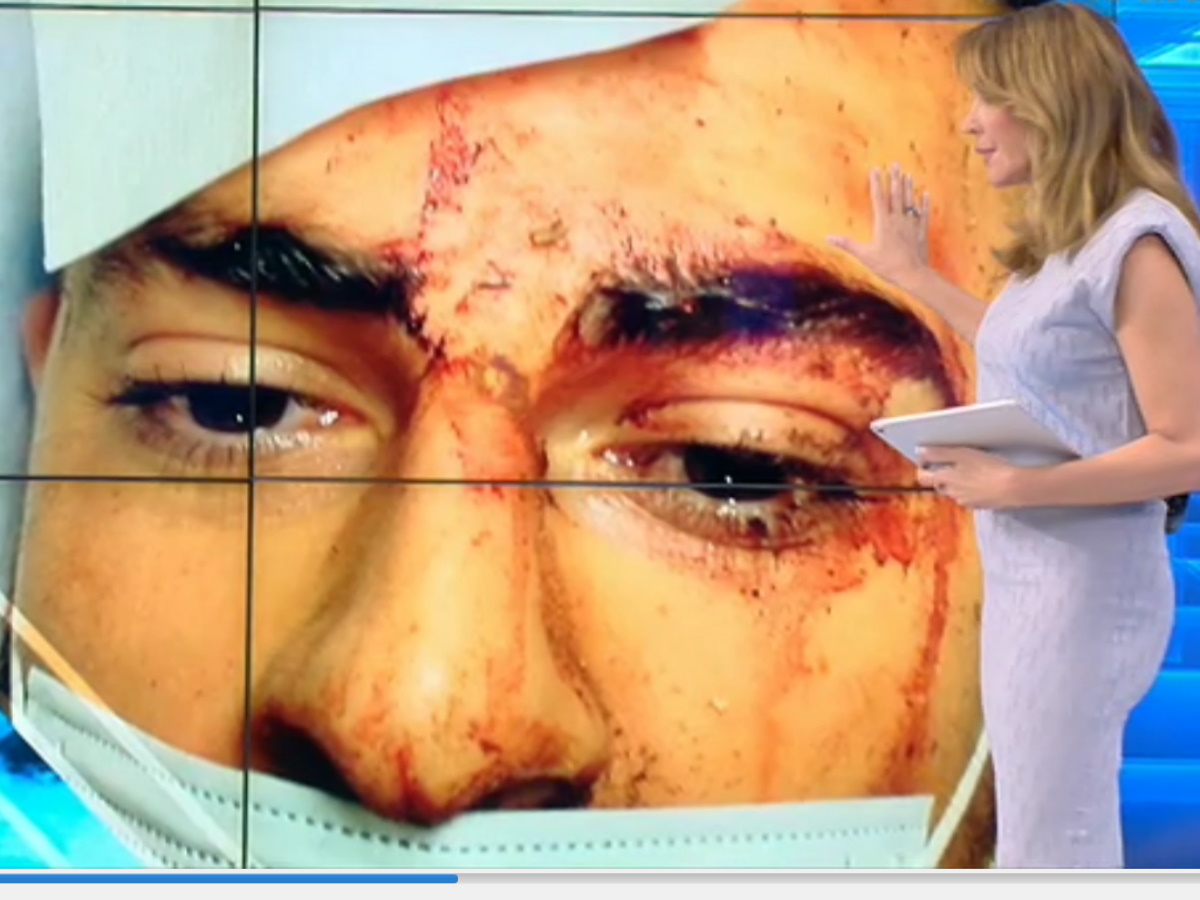 Ατύχημα σε λούνα παρκ: Σοκάρουν οι φωτογραφίες του τραυματισμένου 25χρονου που επέβαινε στο βαγόνι